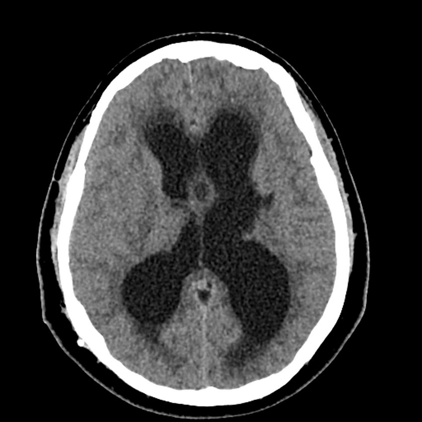 Chiasmatic-hypothalamic juvenile pilocytic astrocytoma (Radiopaedia 78533-91237 Axial non-contrast 32).jpg