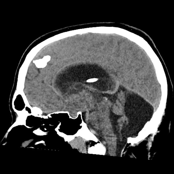 File:Chiasmatic-hypothalamic juvenile pilocytic astrocytoma (Radiopaedia 78533-91237 B 33).jpg