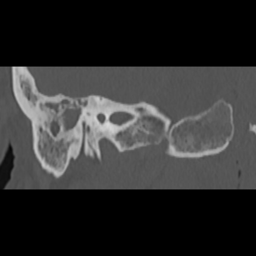 Cholesteatoma (Radiopaedia 68176-77673 Coronal bone window 48).jpg
