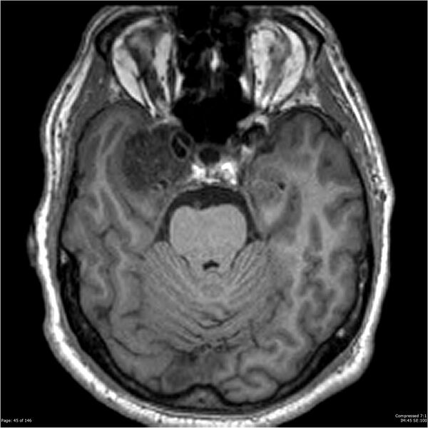 File:Chondrosarcoma of skull base- grade II (Radiopaedia 40948-43654 Axial T1 45).jpg