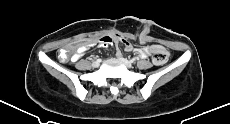 File:Choriocarcinoma liver metastases (Radiopaedia 74768-85766 A 145).jpg