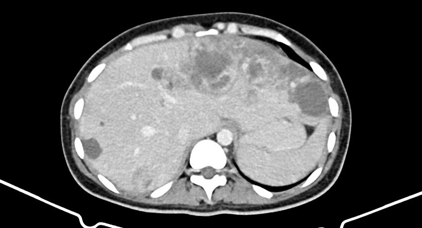 Choriocarcinoma liver metastases (Radiopaedia 74768-85766 A 43).jpg
