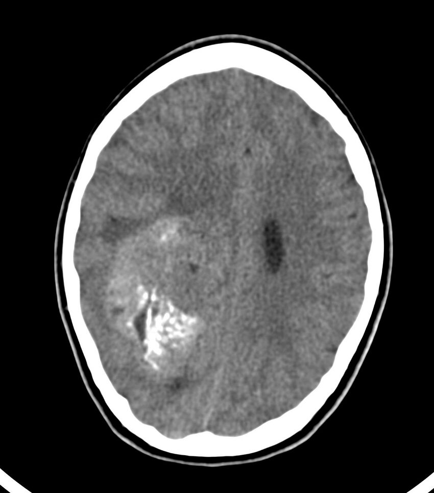 Choroid plexus carcinoma (Radiopaedia 91013-108552 Axial non-contrast 40).jpg