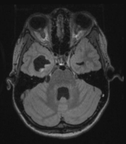 File:Choroid plexus carcinoma (Radiopaedia 91013-108553 Axial FLAIR C+ 102).jpg