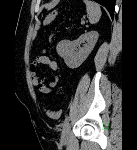 File:Chromophobe renal cell carcinoma (Radiopaedia 84286-99573 C 44).jpg