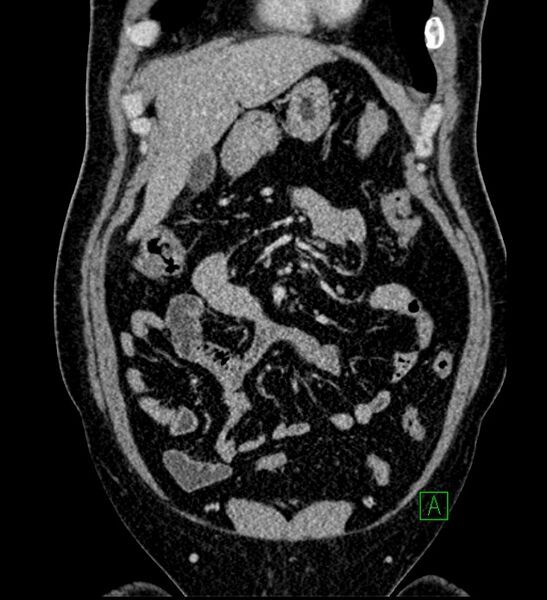 File:Chromophobe renal cell carcinoma (Radiopaedia 84286-99573 H 49).jpg