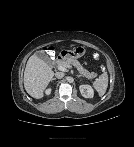 File:Chromophobe renal cell carcinoma (Radiopaedia 84337-99644 C 44).jpg