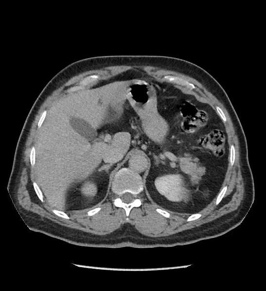 File:Chromophobe renal cell carcinoma (Radiopaedia 86879-103083 D 33).jpg