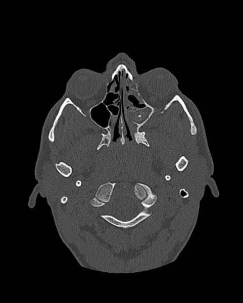 File:Chronic maxillary sinusitis caused by a foreign body (Radiopaedia 58521-65676 Axial bone window 169).jpg