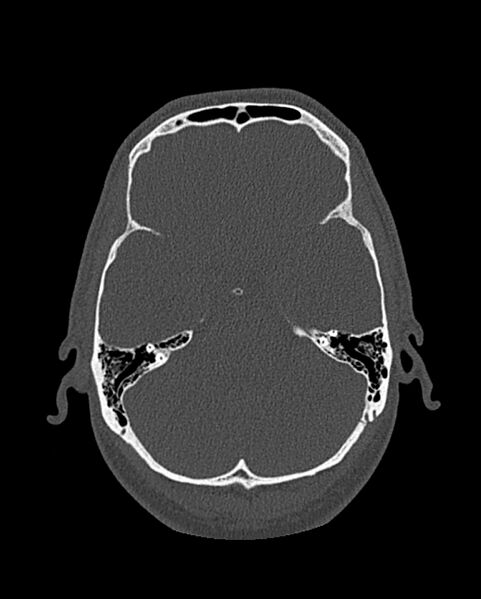 File:Chronic maxillary sinusitis caused by a foreign body (Radiopaedia 58521-65676 Axial bone window 280).jpg