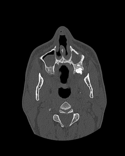 File:Chronic maxillary sinusitis caused by a foreign body (Radiopaedia 58521-65676 Axial bone window 65).jpg