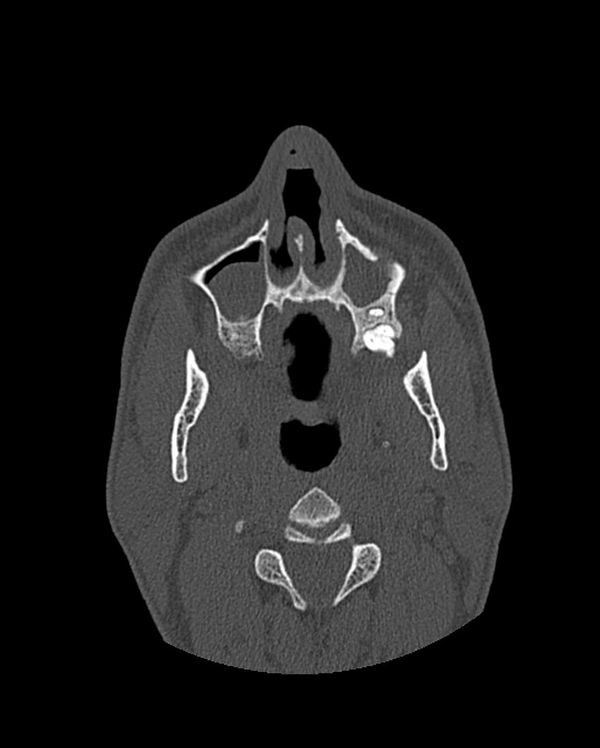 Chronic maxillary sinusitis caused by a foreign body (Radiopaedia 58521-65676 Axial bone window 65).jpg
