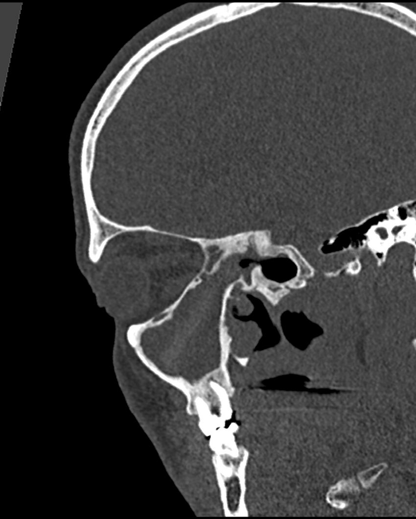 Chronic maxillary sinusitis caused by a foreign body (Radiopaedia 58521-65676 Sagittal bone window 35).jpg
