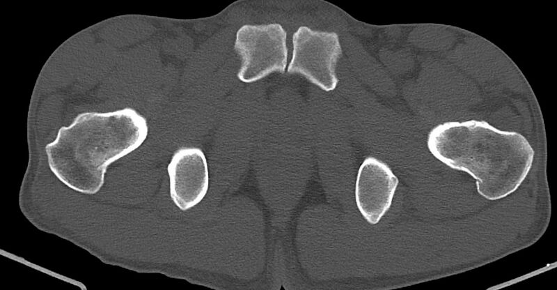 File:Chronic osteomyelitis (with sequestrum) (Radiopaedia 74813-85822 Axial 121).jpg