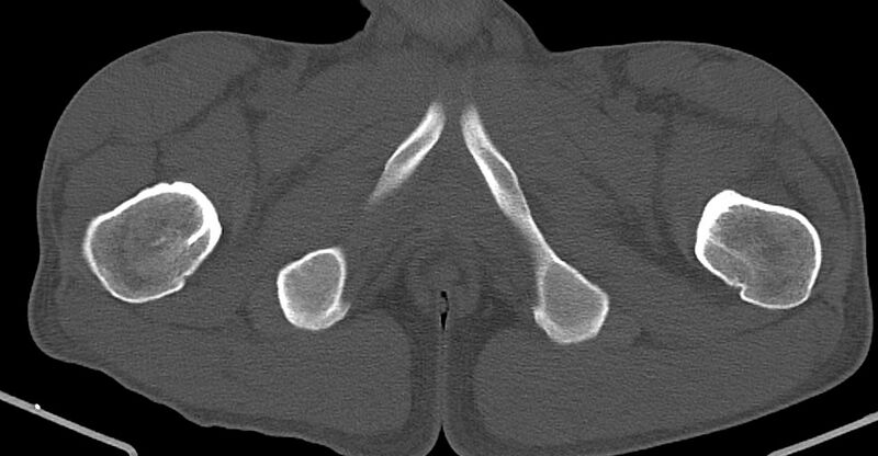 File:Chronic osteomyelitis (with sequestrum) (Radiopaedia 74813-85822 Axial non-contrast 52).jpg