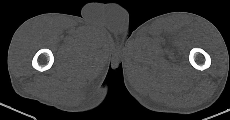 File:Chronic osteomyelitis (with sequestrum) (Radiopaedia 74813-85822 Axial non-contrast 68).jpg