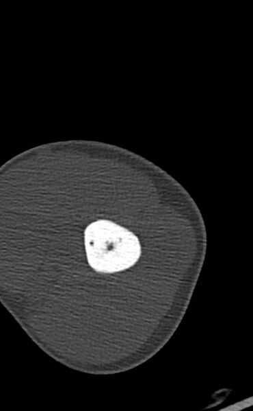 File:Chronic osteomyelitis of the distal humerus (Radiopaedia 78351-90971 Axial bone window 42).jpg
