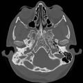 Chronic otomastoiditis (Radiopaedia 27138-27309 Axial bone window 15).jpg