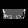 Chronic otomastoiditis (Radiopaedia 27138-27309 Coronal bone window 19).jpg
