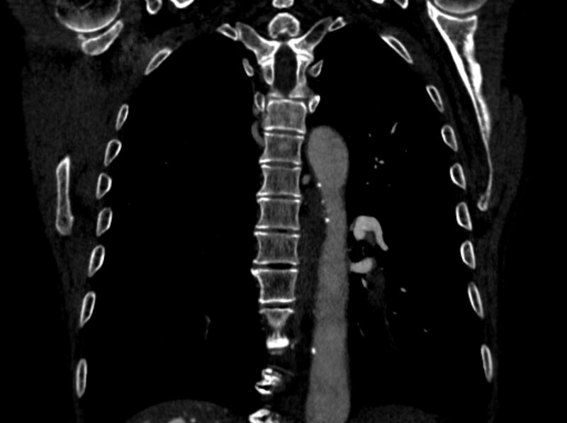 File:Chronic pulmonary embolism (Radiopaedia 91241-108843 A 77).jpg