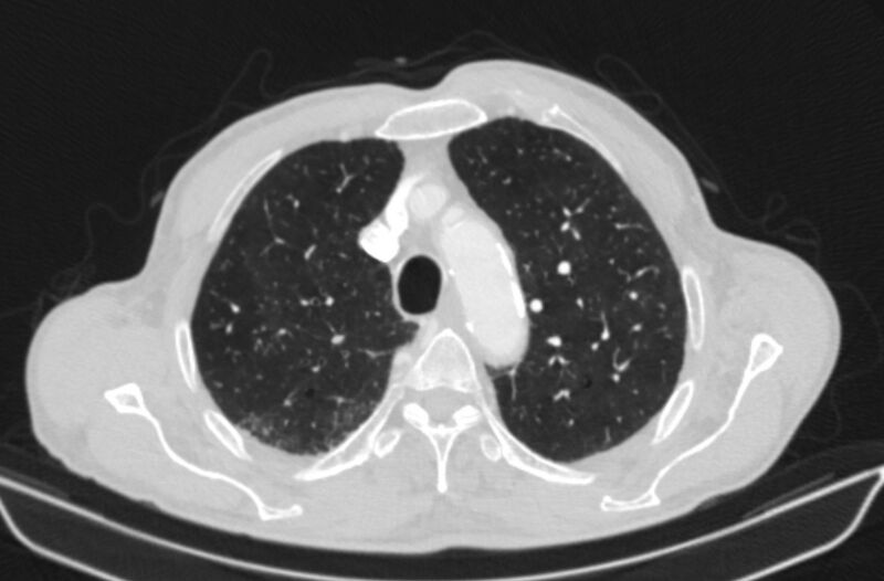 File:Chronic pulmonary embolism (Radiopaedia 91241-108843 Axial lung window 21).jpg