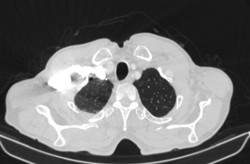 File:Chronic pulmonary embolism (Radiopaedia 91241-108843 Axial lung window 7).jpg