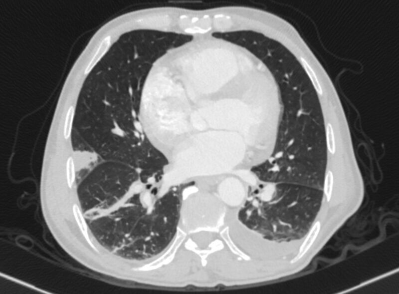 File:Chronic pulmonary embolism with bubbly consolidation (Radiopaedia 91248-108850 Axial lung window 100).jpg
