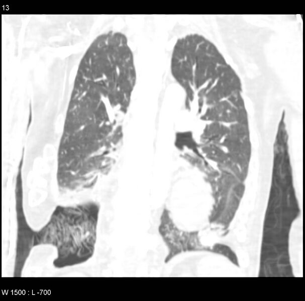 File:Clagett thoracotomy (Radiopaedia 8568-9403 Coronal lung window 13).jpg