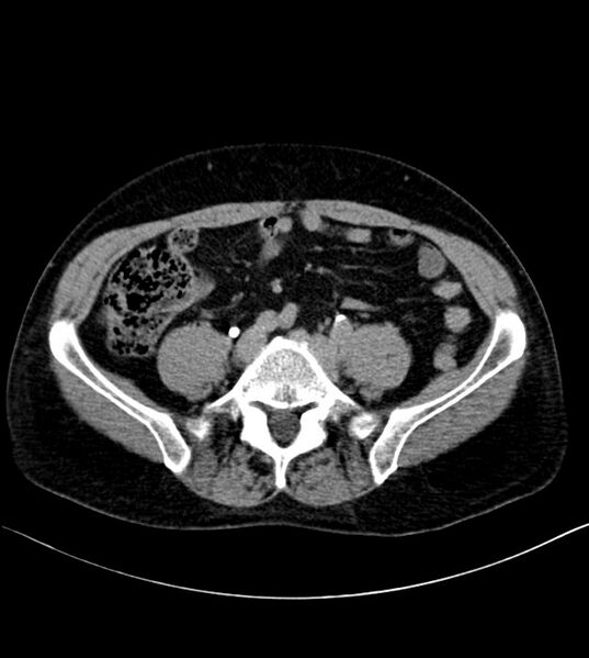 File:Clear cell renal cell carcinoma (Radiopaedia 85006-100539 H 40).jpg