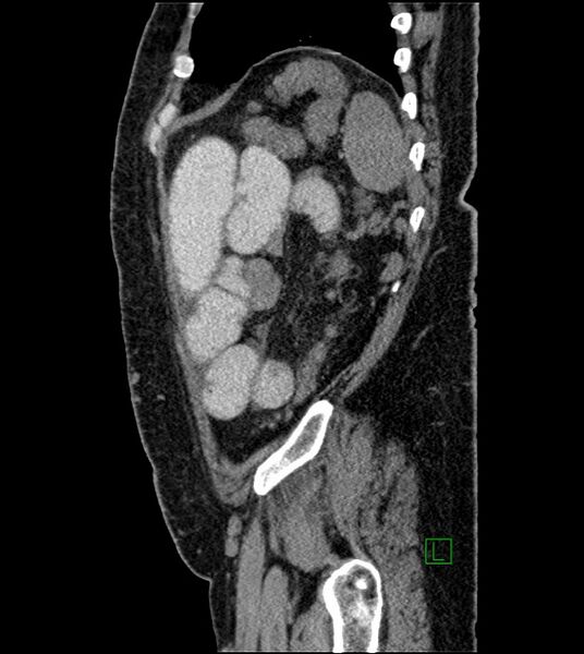 File:Closed-loop small bowel obstruction-internal hernia (Radiopaedia 78439-91096 C 34).jpg