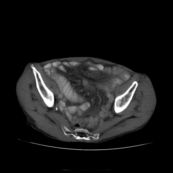 File:Closed loop small intestinal obstruction (Radiopaedia 16156-15835 Axial non-contrast 10).png