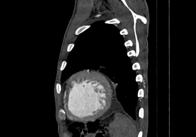 File:Coarctation of aorta with aortic valve stenosis (Radiopaedia 70463-80574 B 200).jpg