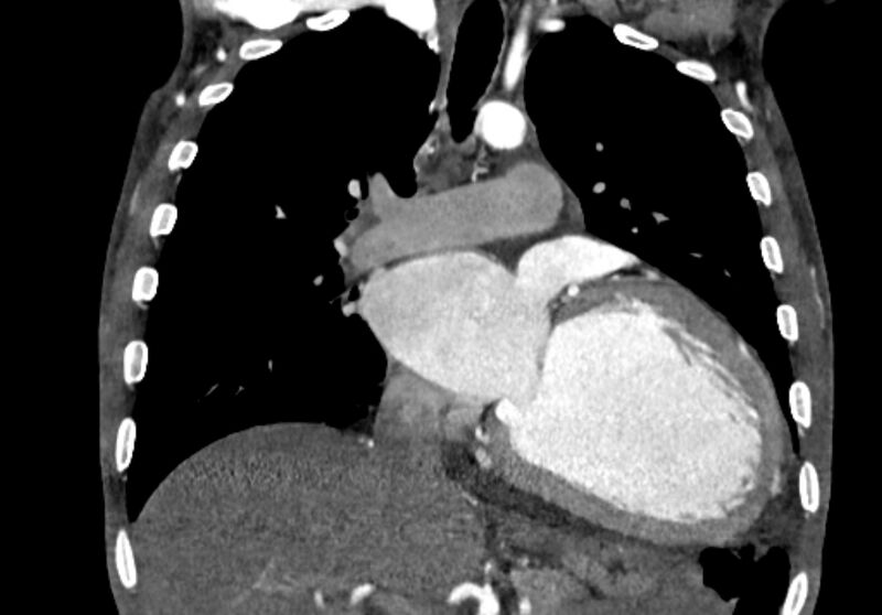 File:Coarctation of aorta with aortic valve stenosis (Radiopaedia 70463-80574 C 109).jpg