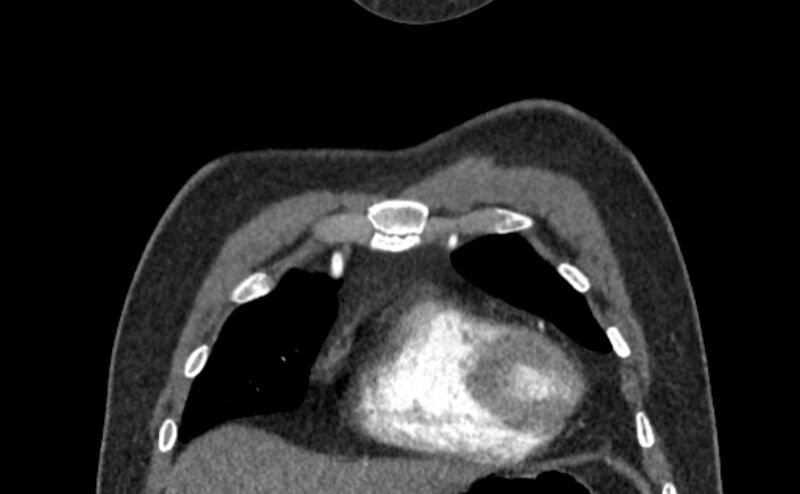 File:Coarctation of the aorta (Radiopaedia 53363-59343 C 9).jpg