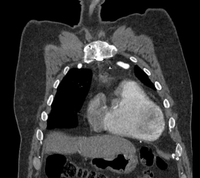File:Coarctation of the aorta (Radiopaedia 53752-59822 B 18).jpg