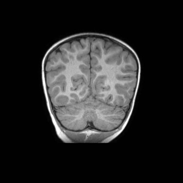 File:Cochlear nerve aplasia - unilateral (Radiopaedia 87910-104413 Coronal T1 41).jpg