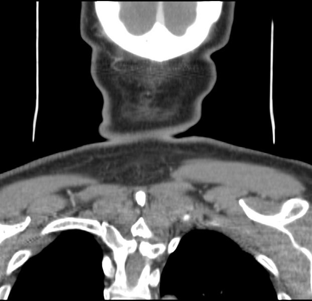 File:Colloid cyst of thyroid (Radiopaedia 22897-22923 Coronal C+ delayed 59).jpg