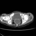 Colocolic fistula - Crohn disease (Radiopaedia 57063-63955 A 90).jpg