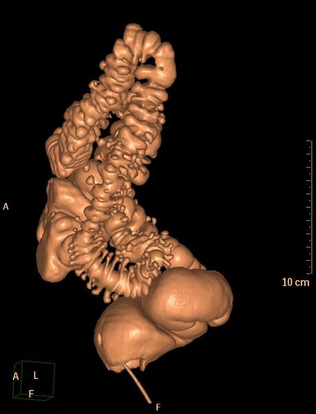 File:Colonic diverticulosis (Radiopaedia 29641-30159 3D VC 17).jpg