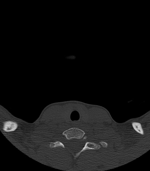 File:Nasoorbitoethmoid fracture (Radiopaedia 90044-107205 Axial bone window 1).jpg