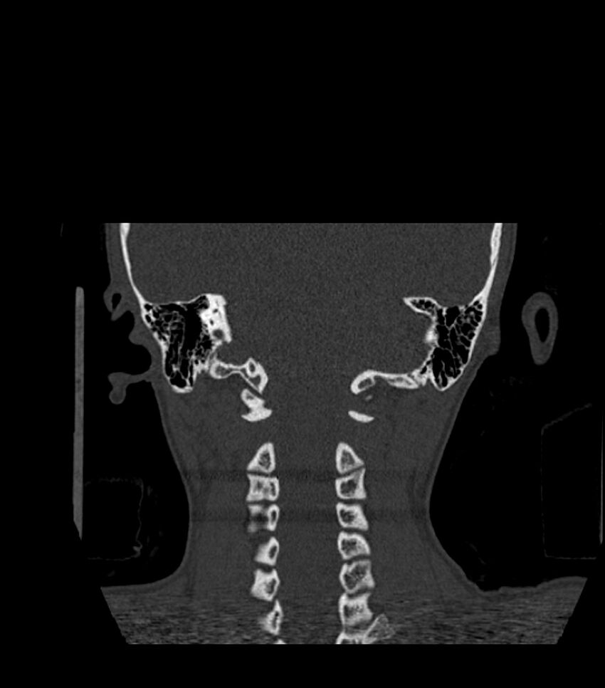 Nasoorbitoethmoid fracture (Radiopaedia 90044-107205 Coronal bone window 115).jpg