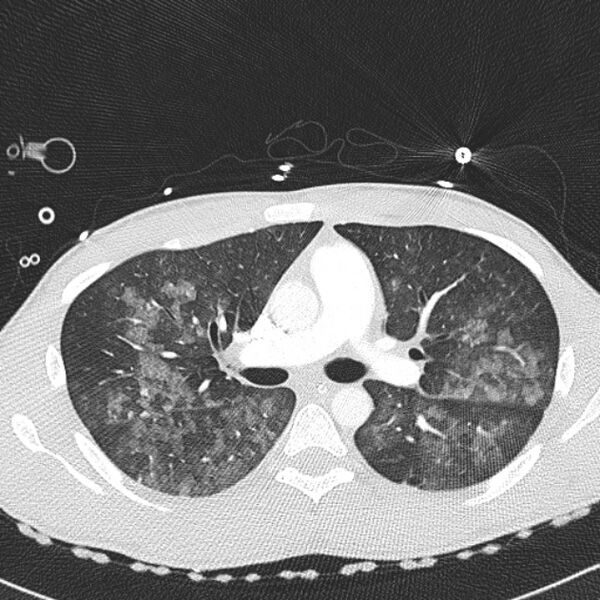 File:Near drowning (pulmonary edema) (Radiopaedia 24685-24958 lung window 18).jpg