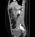 Necrotizing pancreatitis (Radiopaedia 23001-23031 C 28).jpg