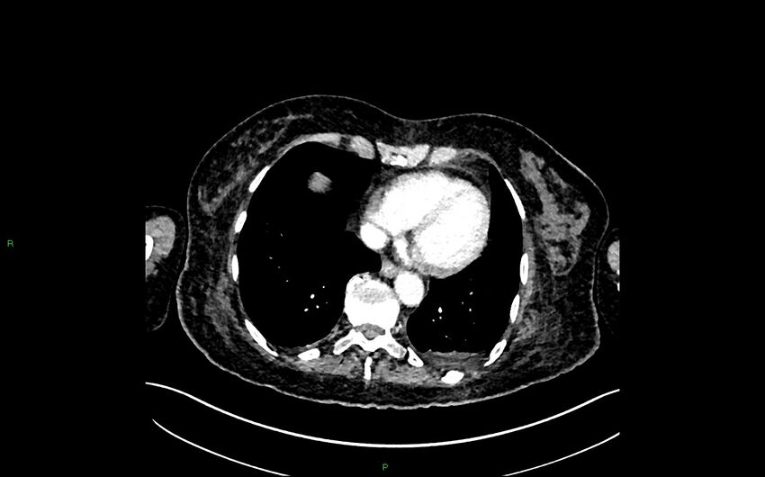 Neo-terminal ileal stricture (Crohn disease) (Radiopaedia 33790-34948 A 3).jpg