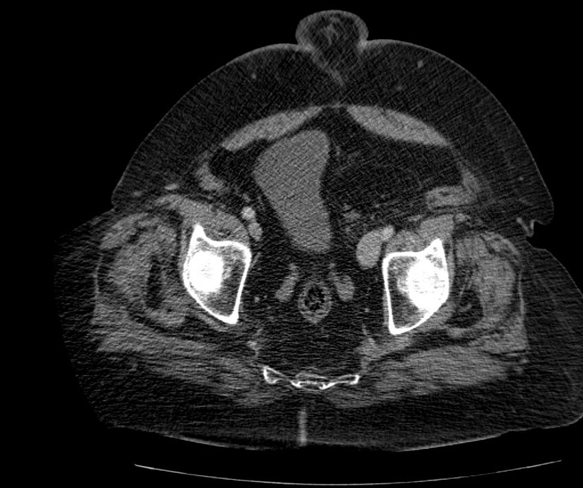 Nephroptosis with inguinal hernia containing perirenal fat (Radiopaedia 56632-63391 C 300).jpg