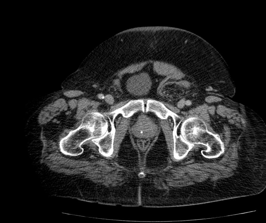 Nephroptosis with inguinal hernia containing perirenal fat (Radiopaedia 56632-63391 C 323).jpg
