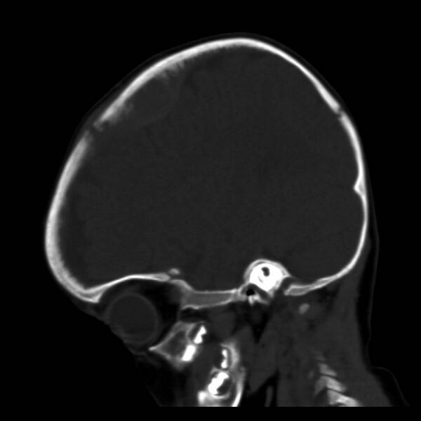 File:Neuroblastoma with skull metastases (Radiopaedia 30326-30958 Sagittal bone window 13).jpg