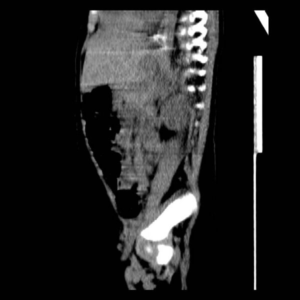 File:Neuroblastoma with skull metastases (Radiopaedia 30326-30960 B 28).jpg