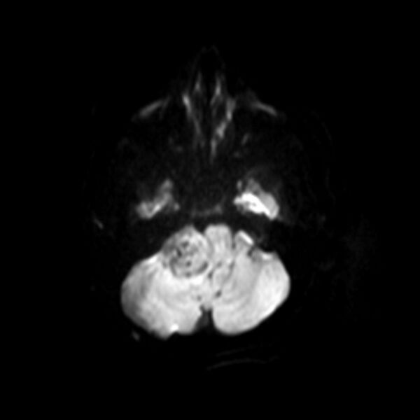 File:Neurofibromatosis type 2 (Radiopaedia 67470-76871 Axial DWI 3).jpg