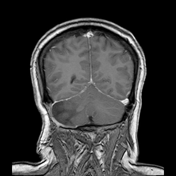 File:Neurofibromatosis type 2 (Radiopaedia 67470-76871 Coronal T1 C+ 19).jpg